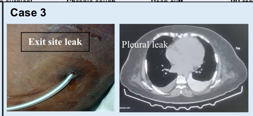 Exit site leak and pleural leak