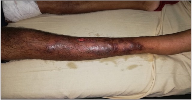 Nodular lesion over the lower limb of case 4