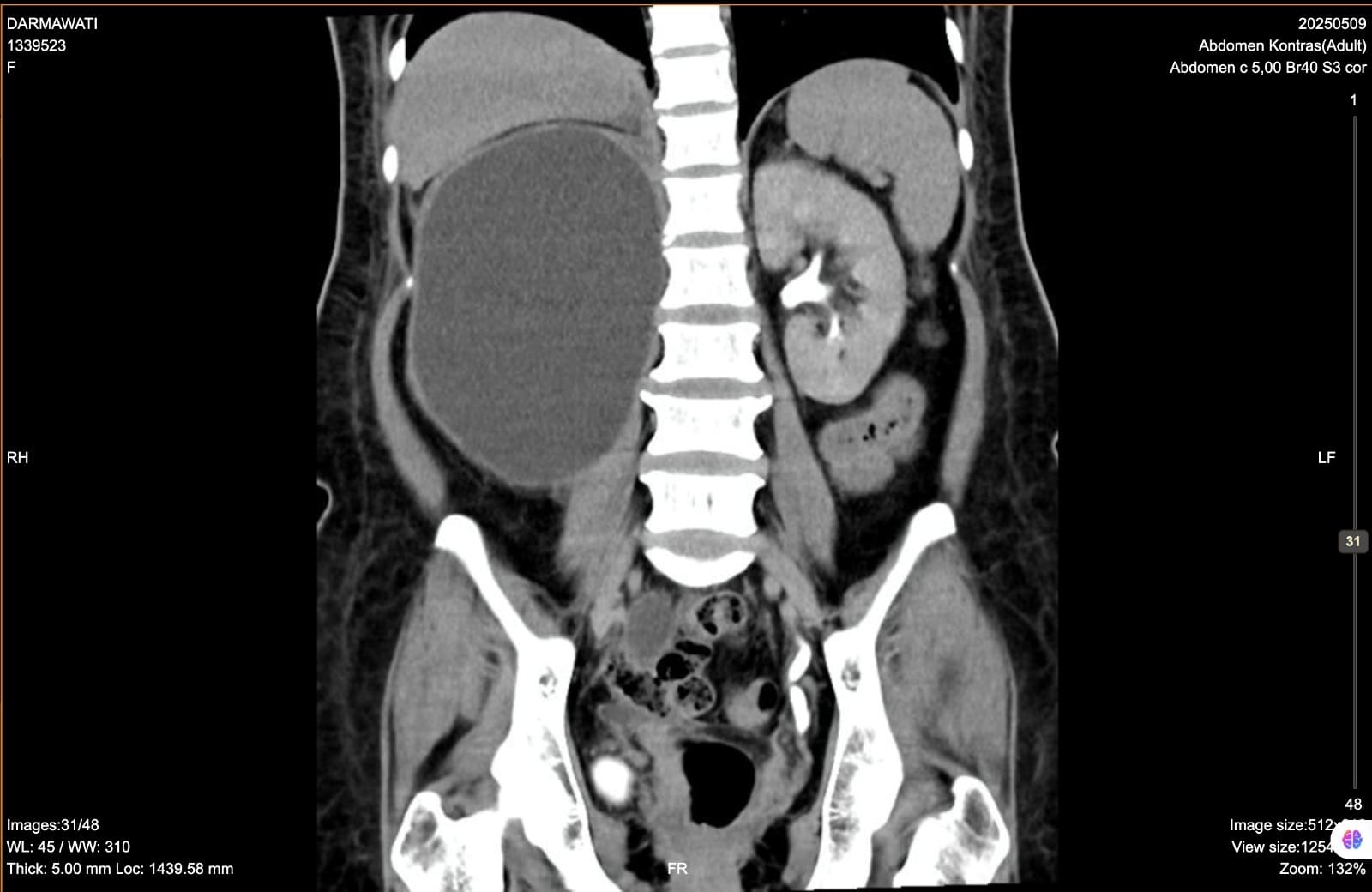 Abdominal CT Contrast