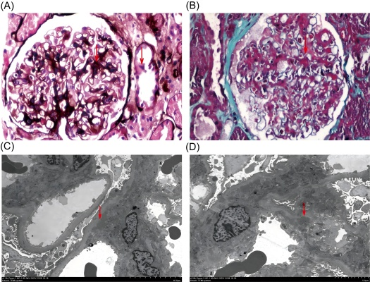 Figure 1 Results of Renal Biopsy (A&B) Light microscope: (A) : (PASM and HE,x400) Red arrows show expansion of the mesangial area and acute tubular injury. (B) : (Masson staining,x400)   Red arrows show expansion of the mesangial area. (C&D) Electron microscopy: (C) : Red arrows denote the deposition of electron-dense material. (D) : Red arrows denote the deposition of electron-dense material.