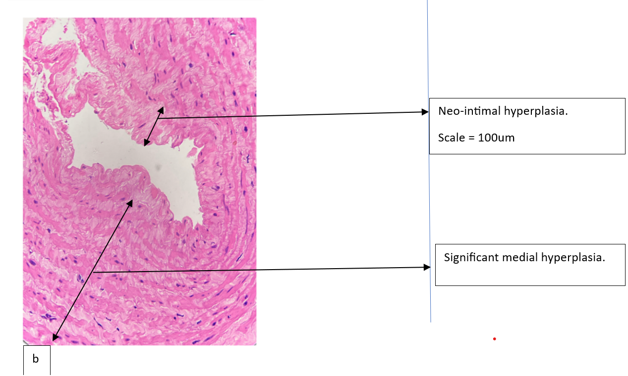 Figure 2b: Image showing significant medial fibrosis (Hematoxylin &Eosin stain).