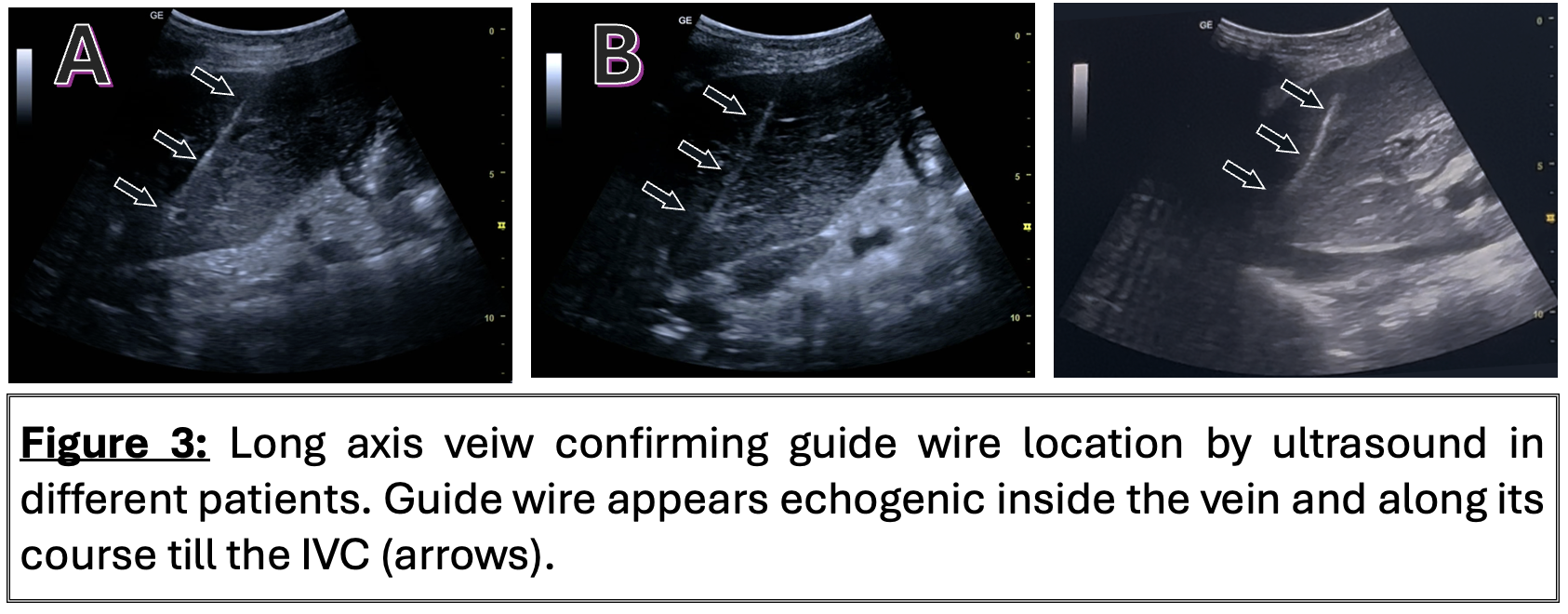 Figure 3: Long axis veiw confirming guide wire location by ultrasound in different patients. Guide wire appears echogenic inside the vein and along its course till the IVC (arrows).