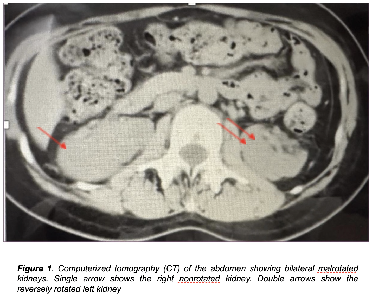 Figure 1. Computerized tomography (CT) of the abdomen showing bilateral malrotated kidneys. Single arrow shows the right nonrotated kidney. Double arrows show the reversely rotated left kidney