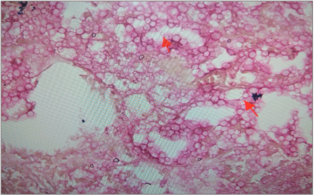 PAS stain of tissue showing fungal infection of case 4