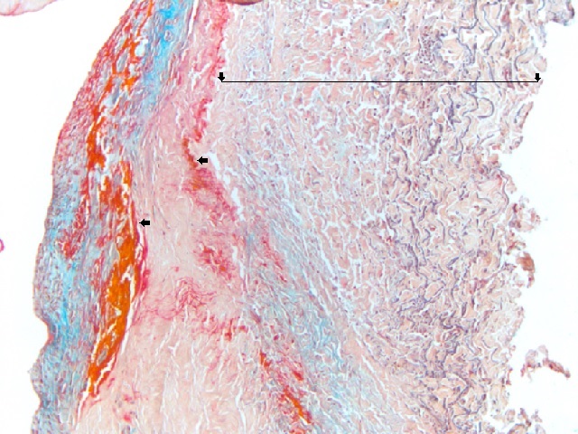 allograft fragment