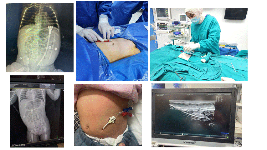 Figure 1: US guided insertion of non-tunneled HD catheter for urgent PD a: Pelvi-abdominal x rays A-P view of intraperitoneal inserted non tunneled HD catheter.  b: Site of catheter after insertion.   c & d: Anterior abdominal wall ultrasound view guided catheter insertion under sterile technique.