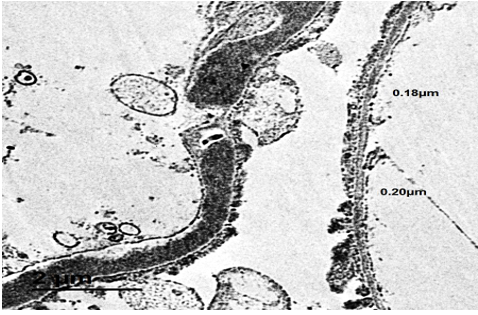 Figure 2: 16 years old female, presented with nephrotic syndrome and persistently low c3.  Light microscopic picture showed FSGS with mesangial hypercellularity. EM showed electron dense materials in GBM with sub-endothelial deposits in the left half of the image. Thin basement membrane was also evident in the biopsy as shown in the right half of the image. Accordingly, the case was diagnosed as dense deposit disease on a background of collagen IV nephropathy.