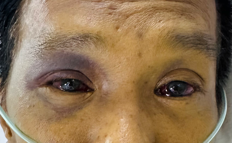 Baseline Jaundice