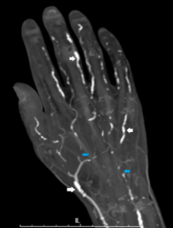 CTA of the right upper extremity
