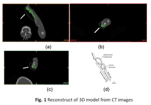 Reconstruct of 3D model from CT images