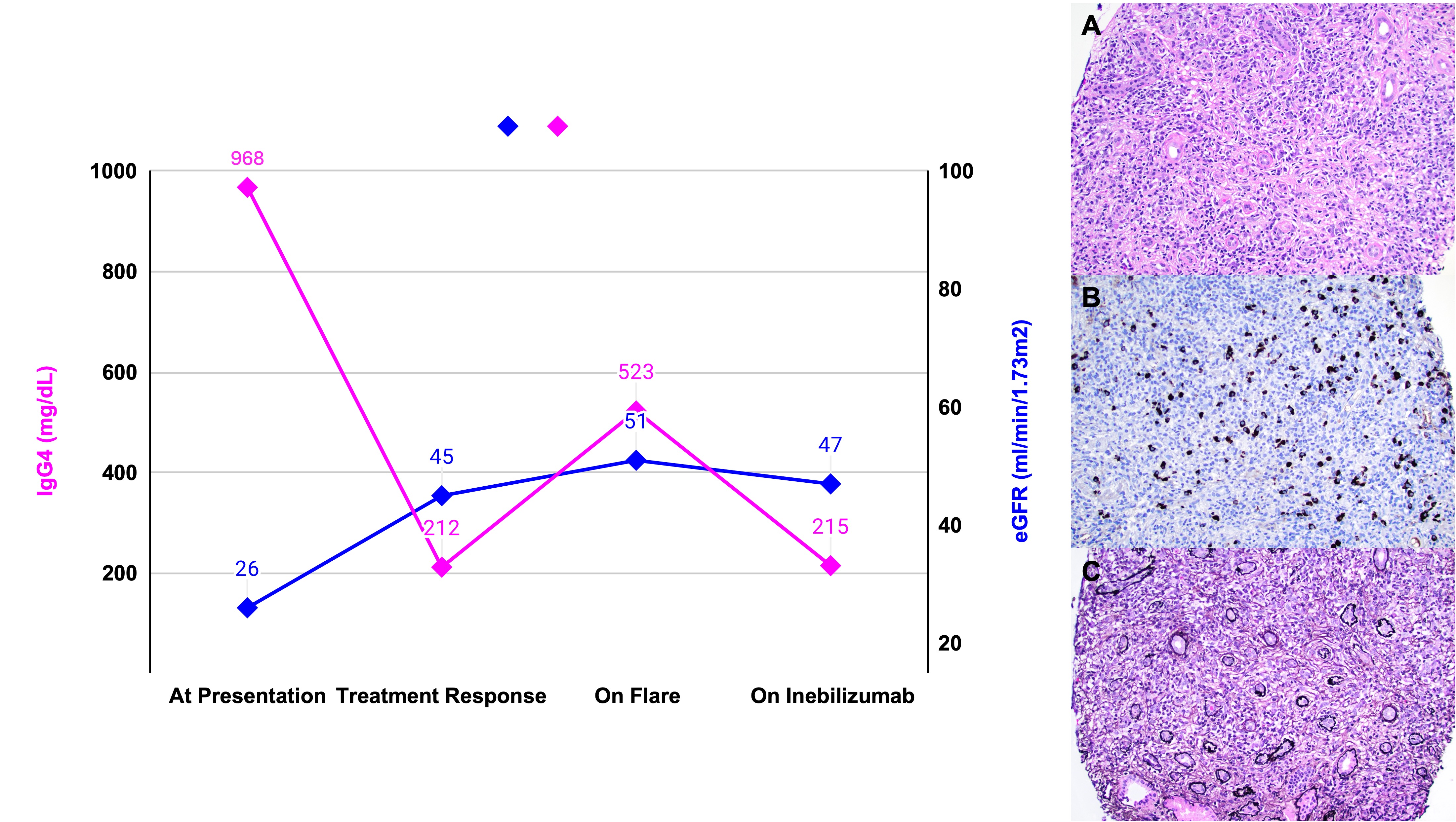 Figure 1. Clinical and histopathologic features of IgG4-related kidney disease. (Left) Trend of serum IgG4 levels and estimated glomerular filtration rate (eGFR) at presentation, after treatment response, on flare, and following initiation of inebilizumab therapy. (Right) Kidney biopsy findings: A) Diffuse severe plasma cell–rich tubulointerstitial inflammation associated with marked expansile interstitial fibrosis and tubular atrophy (H&E; 200× magnification). B) Numerous IgG4⁺ plasma cells (>10 per high-power field) (IgG4 immunostain; 200× magnification). C) Expansile interstitial fibrosis with a characteristic “storiform” or “bird’s-eye” pattern (Jones silver stain; 200× magnification).