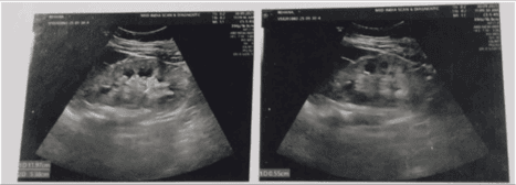Fig. 2 Ultrasound of the kidneys showing renal calculi in left kidney.