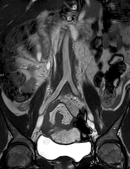 MRI Abdomen