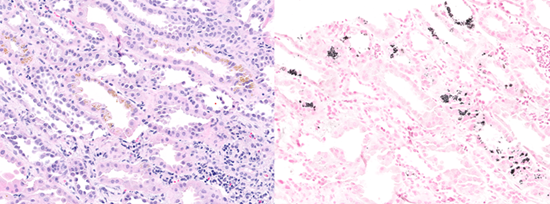 Figure 2. Biopsy shows interstitial inflammation, interstitial edema, and acute tubular epithelial cell injury, highly suspicious for drug-induced acute interstitial nephritis. The glomeruli are unremarkable by light microscopy. IF does not reveal evidence of an immune complex mediated glomerulonephritis. EM demonstrates marked podocyte foot process effacement consistent with acute podocyte injury and correlates with the clinically observed proteinuria. Also noted are scattered tubules with yellow-brown argentaffin-positive cytoplasmic inclusions, which are highly suggestive of melanin pigment. In combination with prominent podocyte foot process effacement, this suggests possible melanuria-induced injury in the setting of melanoma treatment and tumor lysis; 15% glomerular obsolescence and 10% tubulointerstitial scarring indicating mild chronicity. Additional special stains were performed to evaluate tubular cytoplasmic granules: Prussian blue: negative for iron, argues against hemosiderin. Argentaffin: positive, in tubular cytoplasmic granules, suggestive of melanin. Key: UACR- Urine albumin/creatinine ratio, UPCR- Urine protein/creatinine ratio.