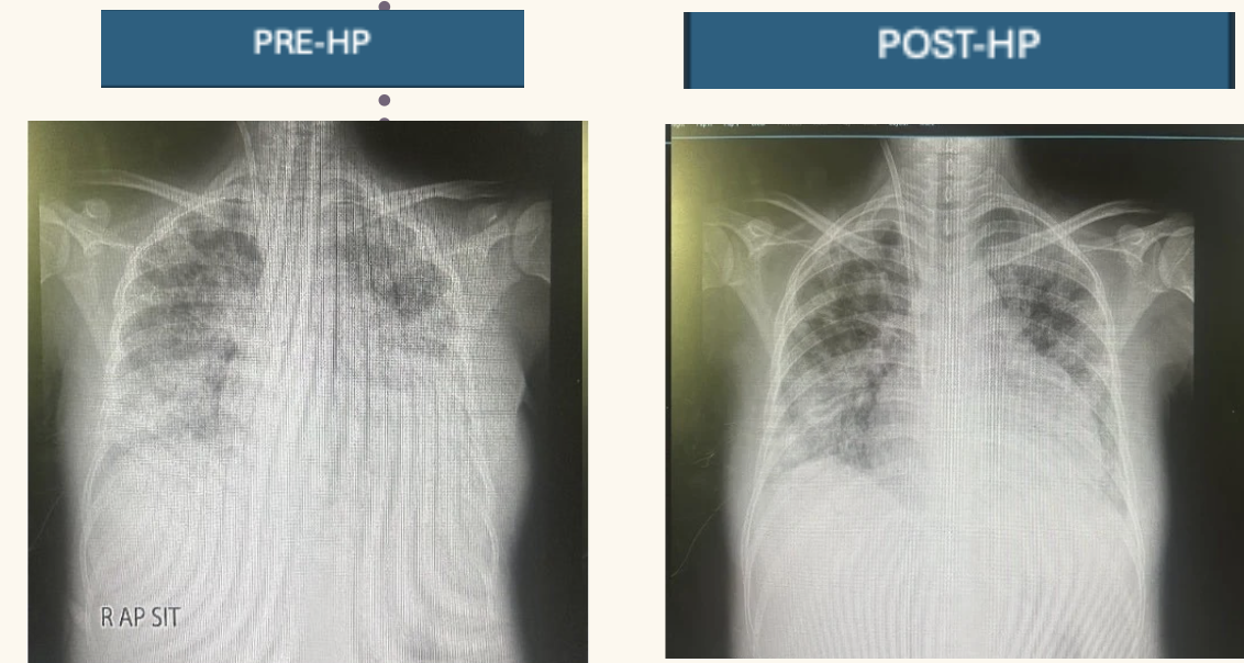 CXR BEFORE AND AFTER HD+HP