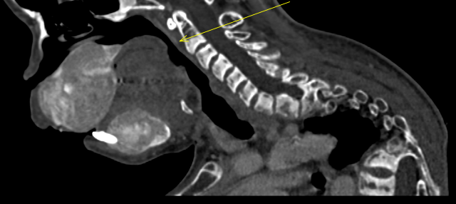 Narrowing of airway due to brown tumours of palate