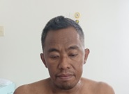 Figure 1. Clinical photograph of the patient showing marked facial edema particularly involving the left periorbital and submandibular regions with visible neck vein distention. The swelling was more pronounced on the left side consistent with venous congestion.