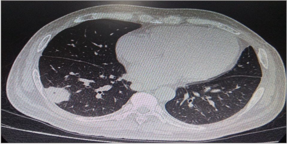 HRCT chest showing right lower lobe consolidation and cavities of Case 1