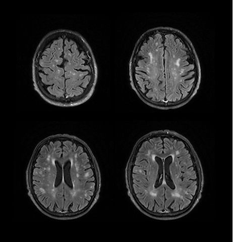 Figure 1. MRI showing multiple foci and hyperintense areas in the white matter of both cerebral hemispheres