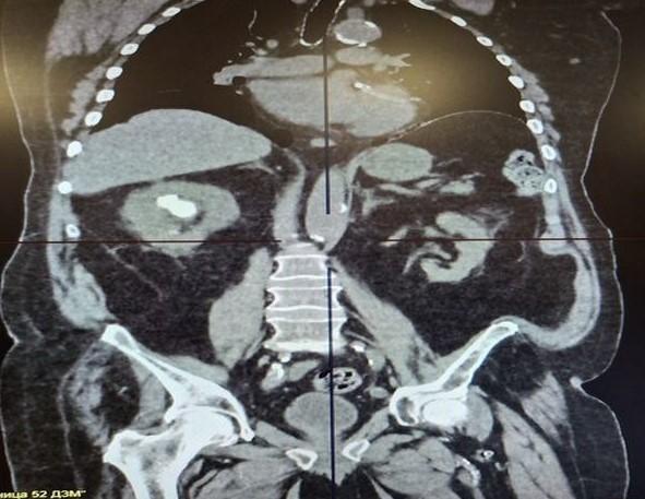 the kidneys