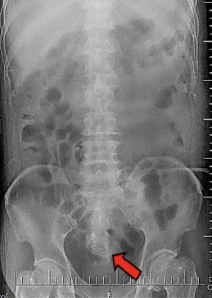 Abdominal radiograph showing the coiled PD catheter tip within the pelvic cavity (red arrow).