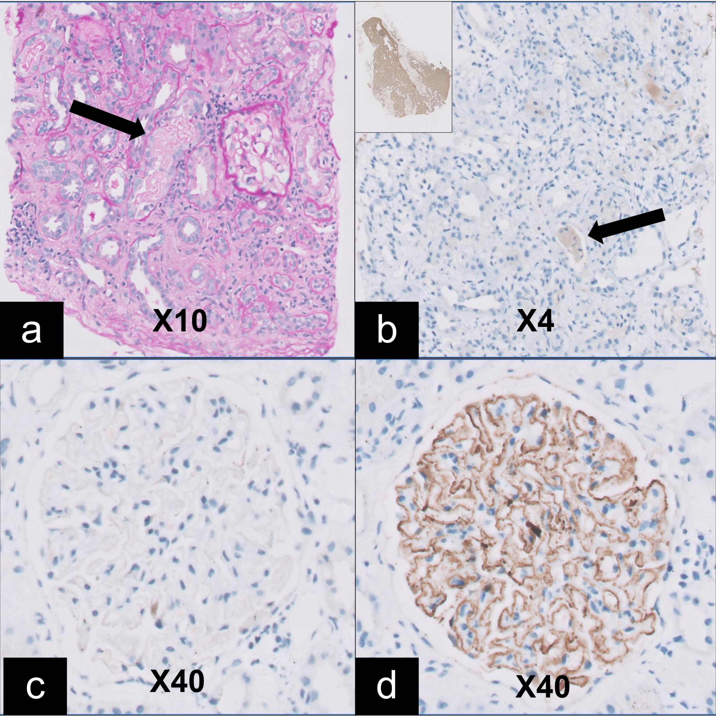 Figure 2: Immunohistochemistry (IHC) for Myoglobin, Neural epidermal growth factor like 1 (NELL-1) and phospholipase A2 receptor (PLA2R).  (a). H&E stain (x10): Case of myoglobin cast nephropathy showing a normal glomerulus, tubular injury and pigmented casts (arrow). (b). Myoglobin IHC for the same case as in part a (x4), showing positive staining. The insert shows a positive control. (c.). NELL-1 IHC showing negative staining. (d). PLA2R showing positive stain with a granular staining pattern.