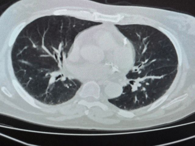 the lungs