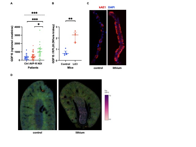 (A) Urinary GDF15-to-creatinine ratio in lithium-treated patients without renal involvement (N), with partial resistance to vasopressin (AVP-R), or with overt nephrogenic diabetes insipidus (NDI).(B) Renal GDF15 mRNA expression assessed by qPCR in mice.(C) Immunostaining of microdissected outer medullary collecting ducts (OMCD) using AE1 antibody, a marker of type A intercalated cells (A-IC).(D) Spatial transcriptomic mapping of GDF15 expression using Visium HD (8-µm resolution).(E–G) Diuresis, proportion of A-ICs, and collecting duct (CD) hyperplasia in wild-type and GDF15⁻/⁻ mice under control or lithium-enriched diet.