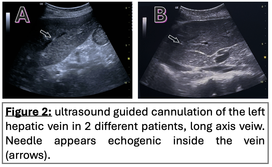 Figure 2: ultrasound guided cannulation of the left hepatic vein in 2 different patients, long axis veiw. Needle appears echogenic inside the vein (arrows).