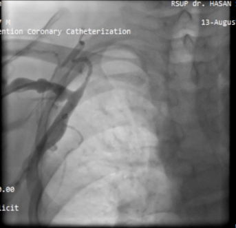 Figure 2. Right Subclavian Vein Occlusion