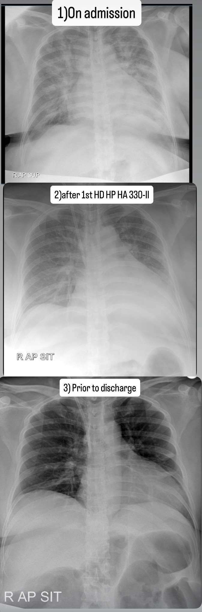 CXR on admission, after first HDHP, prior to discharge
