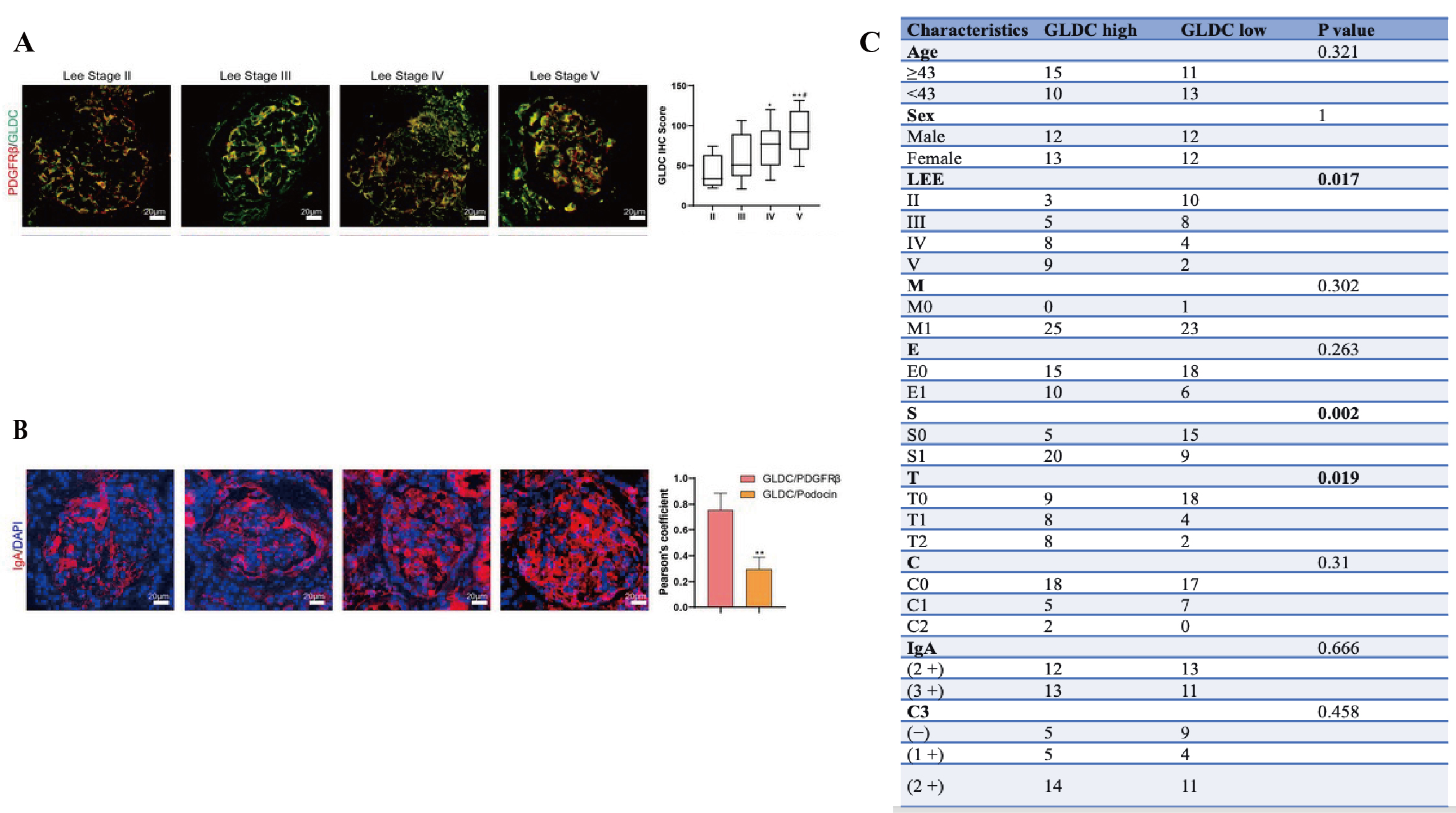 Figure 1 GLDC was highly expressed in IgAN glomeruli and correlated with disease severity. (A) Representative images of GLDC and PDGFRβ co-staining in renal tissues from IgAN patients across different Lee's grades. (B) Quantification of GLDC co-localization with the mesangial cell marker PDGFRβ and the podocyte marker Podocin, demonstrating specific enrichment in mesangial cells. (C) Summary of the correlation between high GLDC expression and key clinicopathological features (Lee's grade, segmental glomerulosclerosis S1, tubular atrophy/interstitial fibrosis T1-2) in 49 IgAN patients.