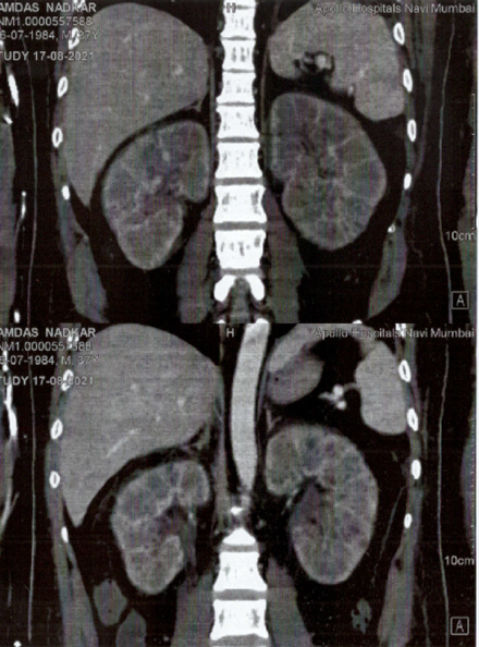 CASE 1 – Bilateral Bulky kidneys with pyelonephritis like picture