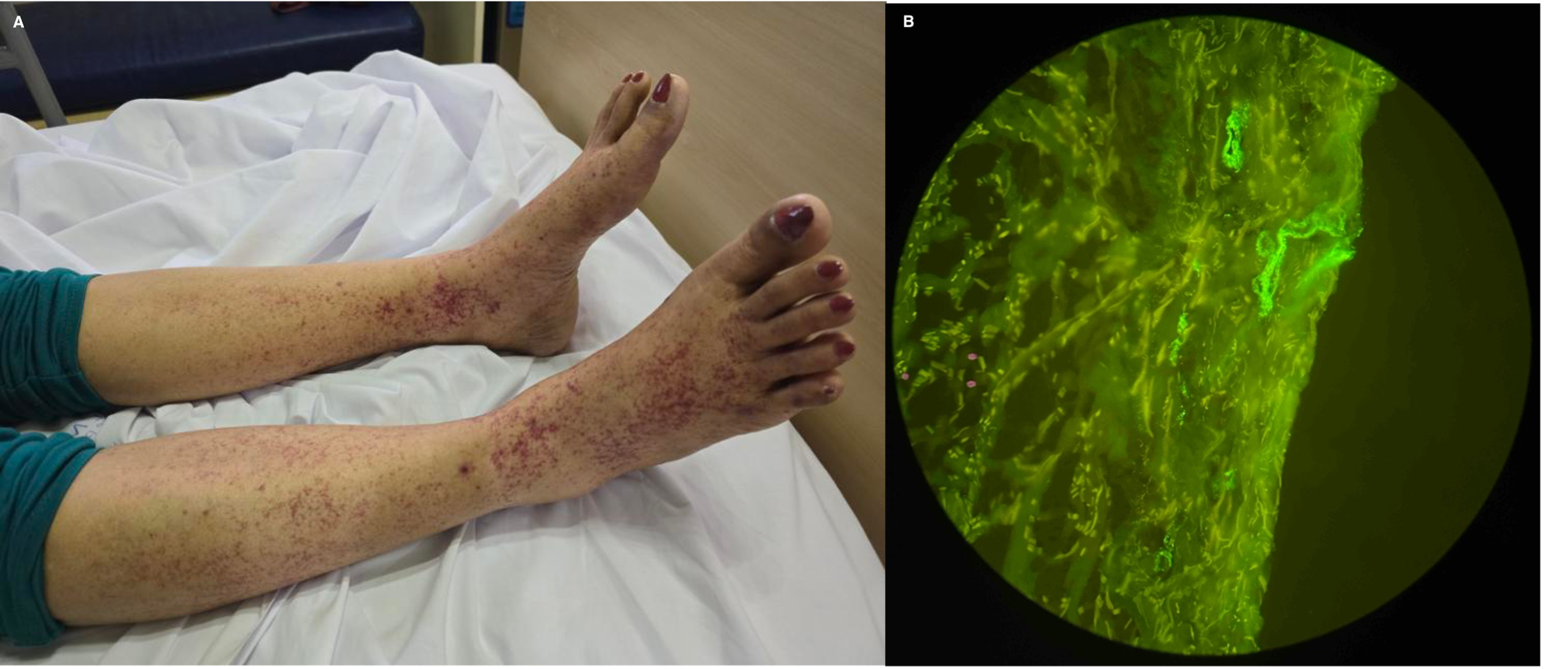 Figure 1. (A) Non-blanching, non-palpable erythematous to violaceous petechiae and macules on both lower extremities. (B) Skin biopsy showing strong IgA deposition along vessel walls, consistent with IgA vasculitis. Image B courtesy of Bernardita Policarpio (2025).