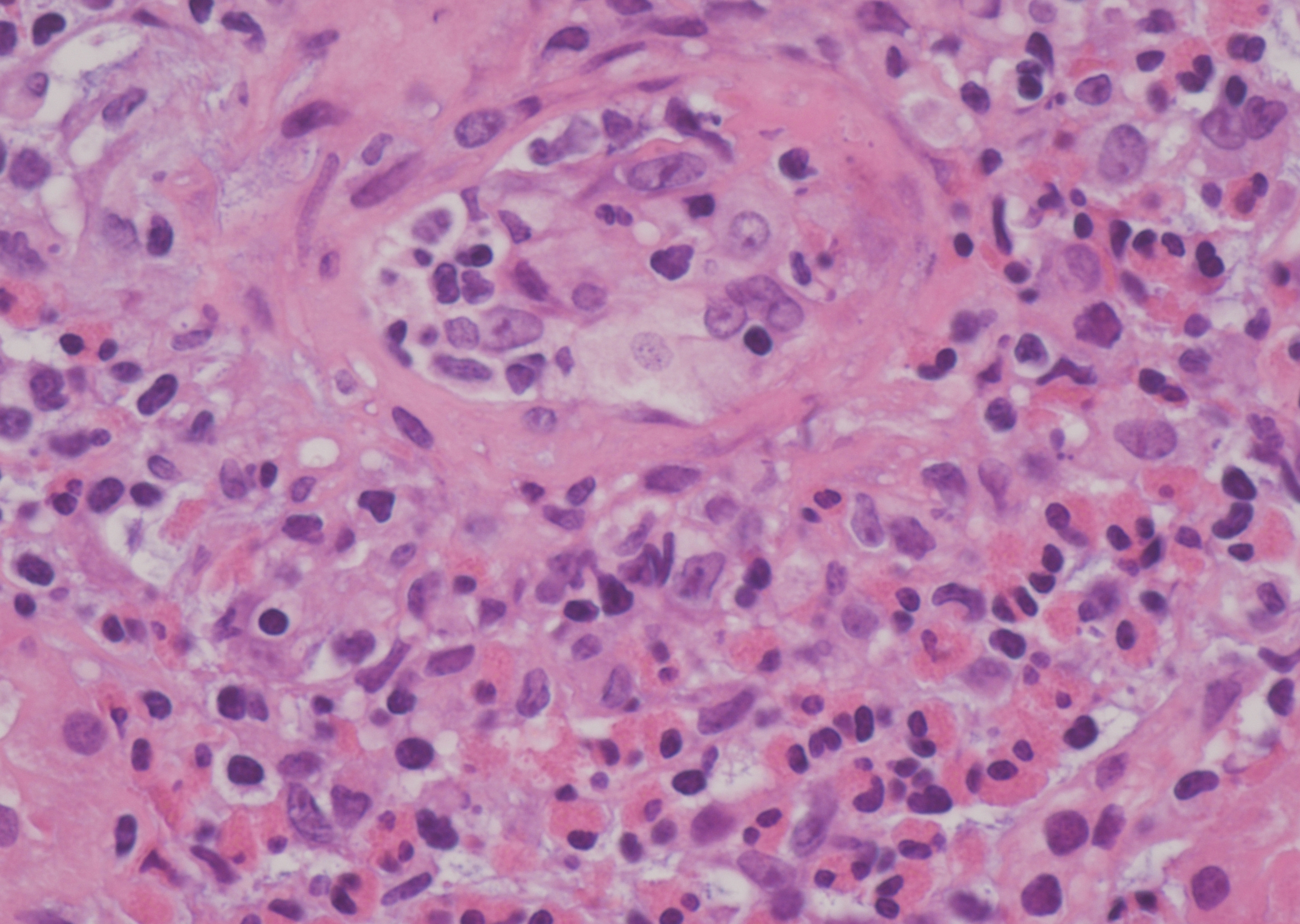 Figure A: Periarterial granulomatous inflammation with extensive eosinophil infiltration.