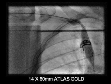 Picture 1: Balloon angioplasty of the right innominate vein showing balloon shouldering at the stenotic segment.