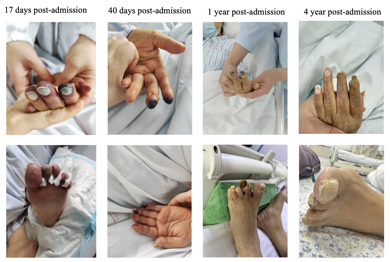 Typical pictures of the limb ischemia and venous limb gangren