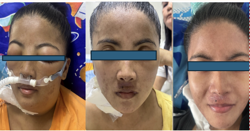 FACIAL EDEMA BEFORE AND AFTER HD+HP