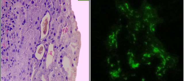 Fig B. Mild increase in mesangial cellularity with 2+ to 3+ IgA deposition in the mesangium