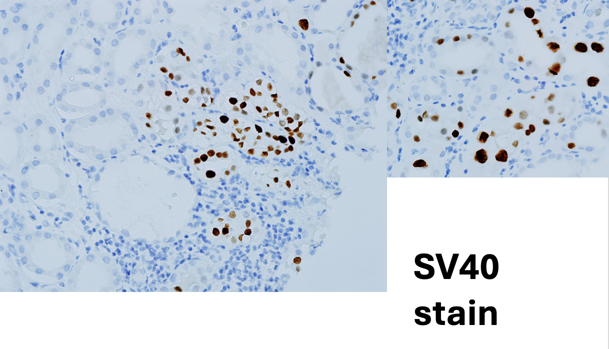 Figure3: Renal allograft Kidney Biopsy - SV40 stain