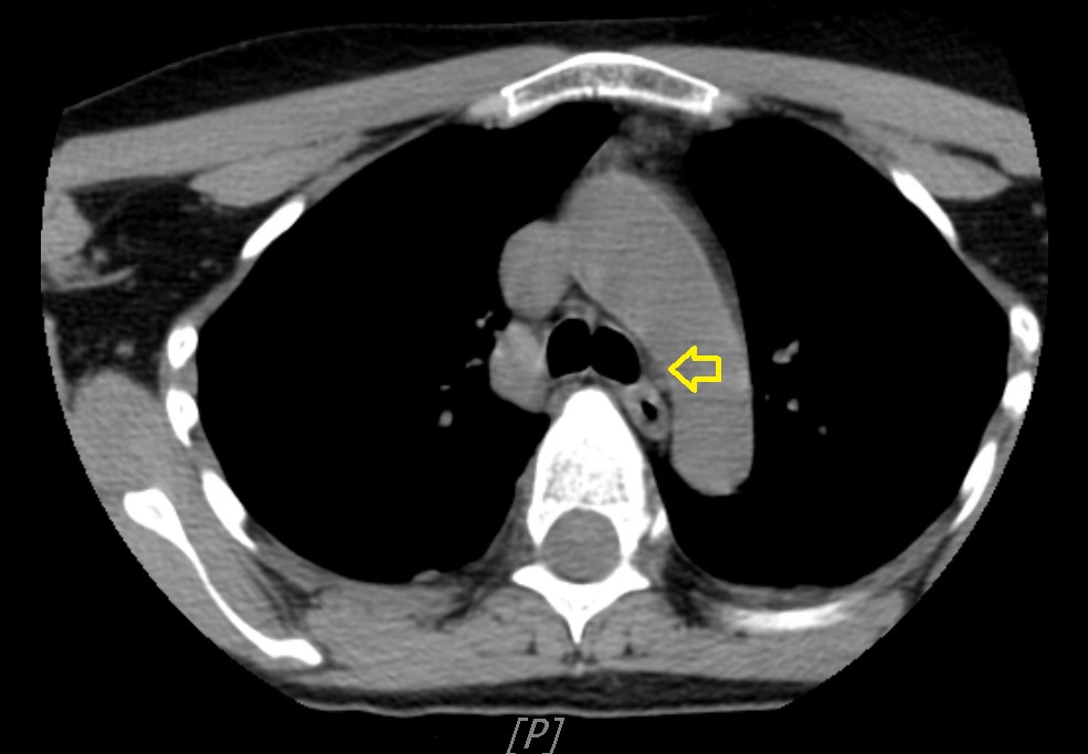 Figure 2: On preoperative CT scan, the ectopic paratracheal parathyroid gland appeared to be of normal size and resembled a typical lymph node.