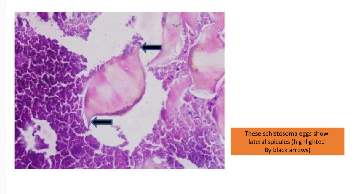 Histopathlogy revealed PAS positive eggs with lateral spines suggestive of Schistosoma mansoni.