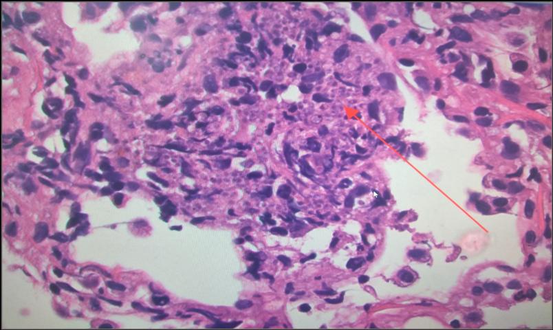 Trans bronchial biopsy Histopathology suggestive of histoplasmosis of case 1