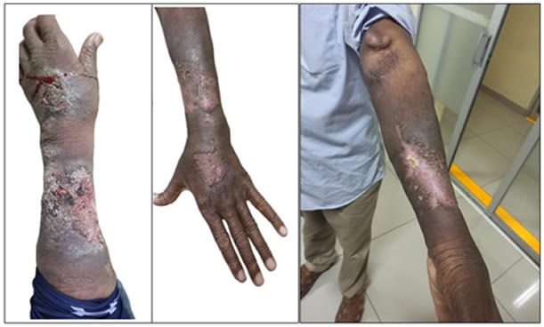 Figure 1. A-Skin lesions, plaque type, marked edema. B/C-Resolution lesions, hypopigmented spot.