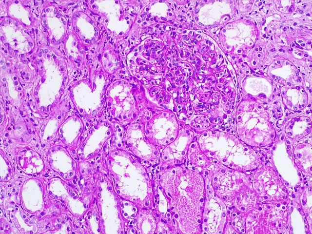 FIGURE 01 - Light microscopy (LM) showing enlarged glomeruli, with diffuse mesangial and endocapillary hypercellularity, with neutrophil infiltration and cellular crescent formation
