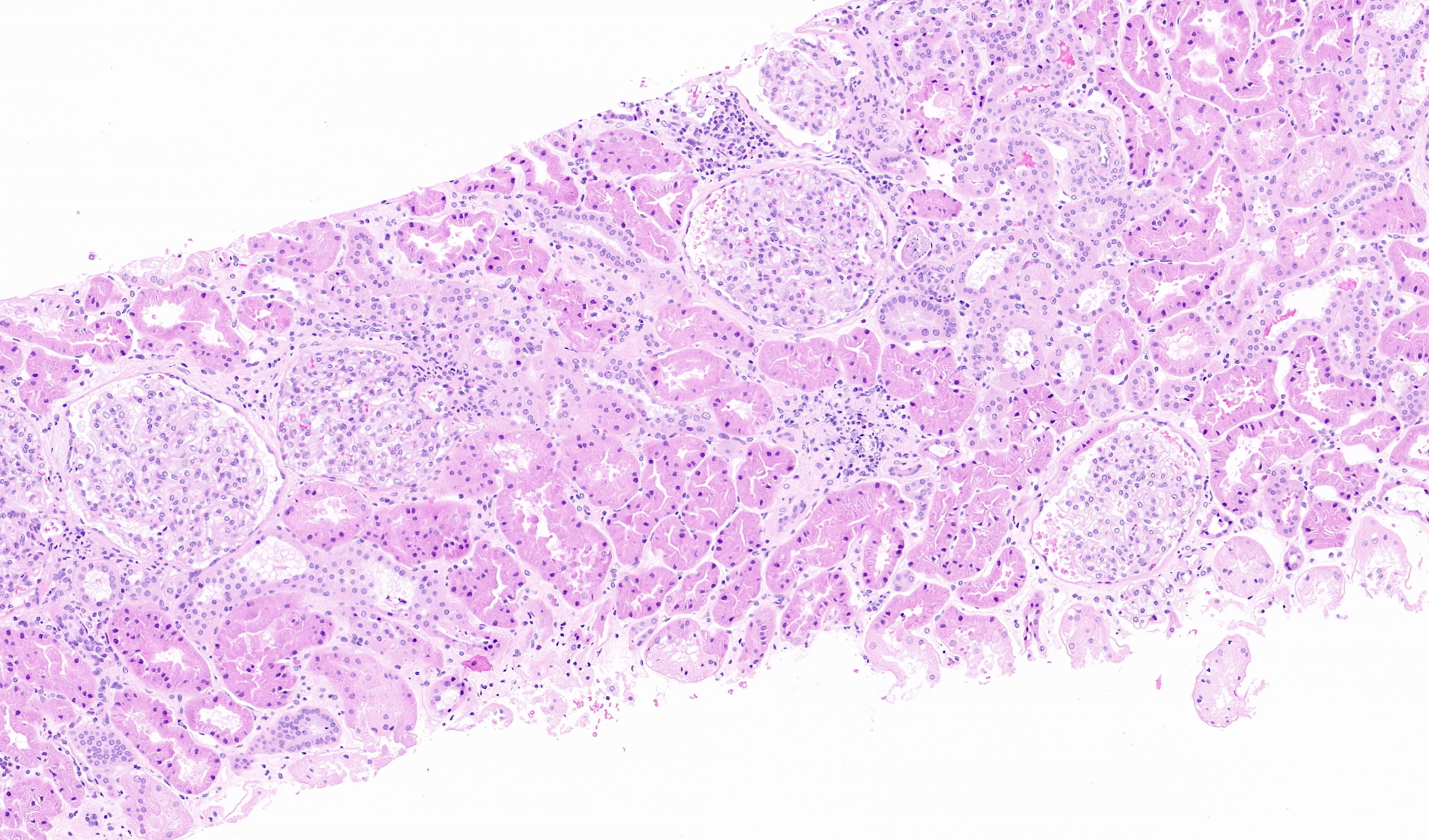 Light Microscopy with focal tubular atrophy and normal glomeruli