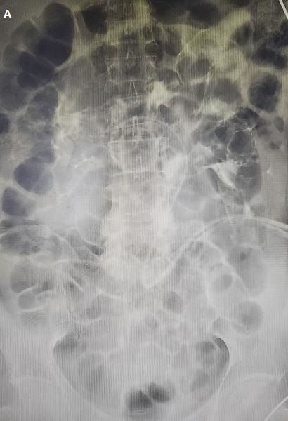 Peritoneal dialysis catheter angiography showed that the contrast agent diffused diffusely in the abdominal cavity.