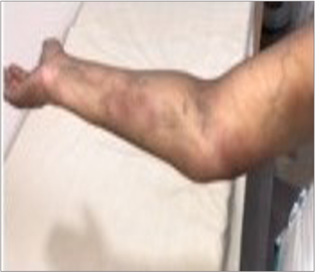 Erythematous nodular swelling of the forearm