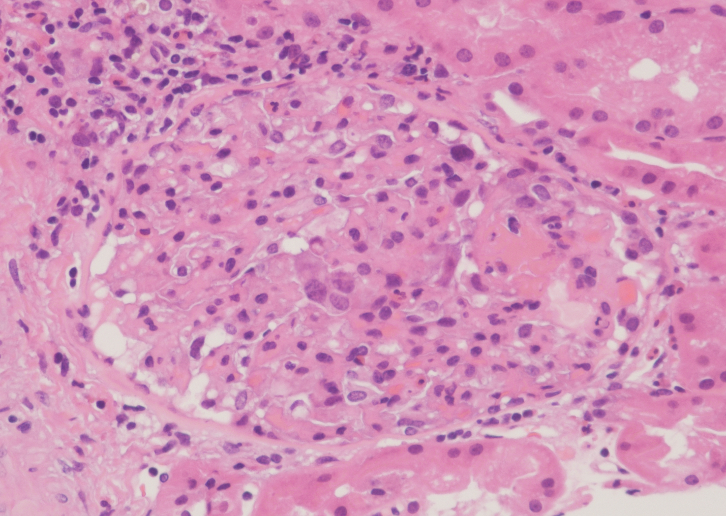 Figure B: Glomerulus with a cellular crescent and eosinophil infiltration.