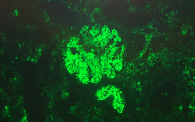 FIGURE 2(B) - Direct immunofluorescence study showed 2+/3+  granular staining of mesangial and capillary wall by C3